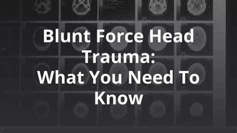 Everything You Need to Know About Blunt Force Head Trauma