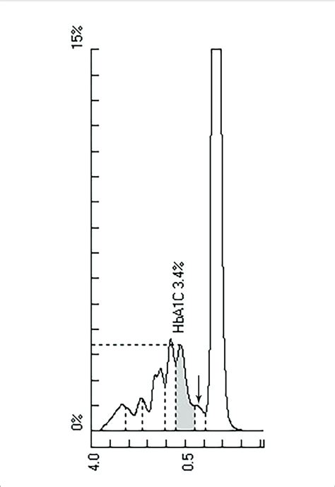 Hplc Chromatogram Of Hba1c Abnormal Peak Marked By Arrow Download