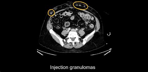 Abdominal Ct Body Wall • Litfl • Radiology Library