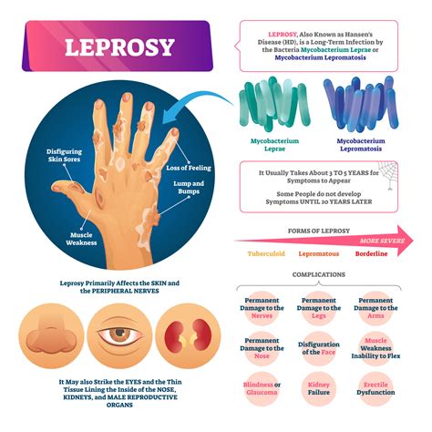 Understanding Leprosy On World Leprosy Day Gideon Global Infectious