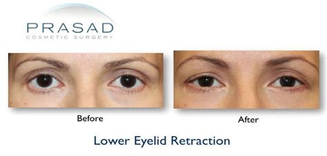 Transconjunctival Blepharoplasty Eyelid Surgery New York City