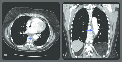 CT angiogram of chest with contrast (a) transaxial and (b) coronal ...