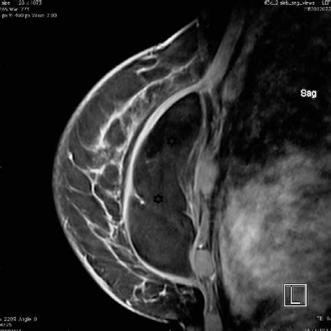 Left Mediolateral Oblique 2a And Craniocaudal 2b Mammograms Showing