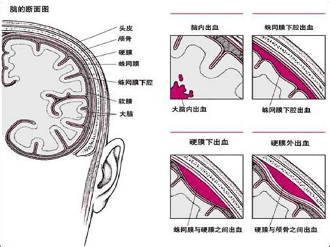 神经外科常见引流管的护理2word文档在线阅读与下载免费文档