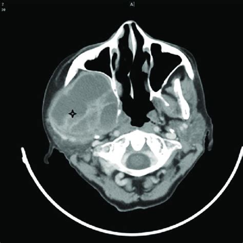 Computed Tomography Showing Solid Cystic Lesion Asterisk Measuring