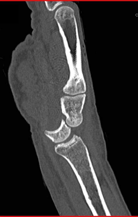 D Imaging Of The Wrist With Lunate Dislocation Musculoskeletal Case