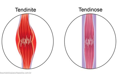 Tendinites Tenossinovites Tendinopatias Tendinoses Traumatologia E Ortopedia