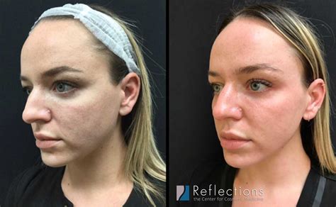 Sofwave Skin Tightening For Woman In Her Late 20s Before And After