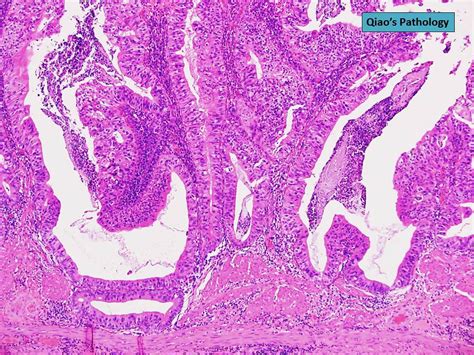 Qiao S Pathology Papillary Carcinoma Of The Gallbladder Flickr