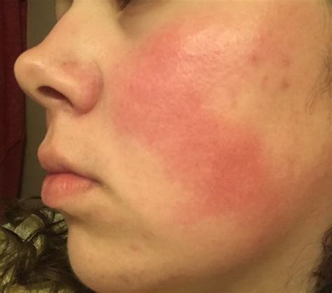 [skin Concerns] My Rosy Red Cheeks Are The Bane Of My Existence R