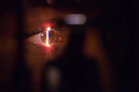 Removing Cornea Transplant Stitches A Crucial Step In Recovery Eye