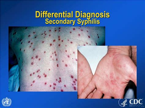 Ppt Evaluating Patients With Acute Generalized Vesicular Or Pustular Rash Illnesses Powerpoint