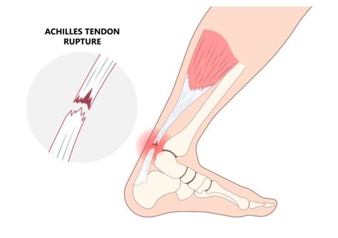 The Signs Of Achilles Tendinopathy Rupture Best Podiatrist In Brooklyn