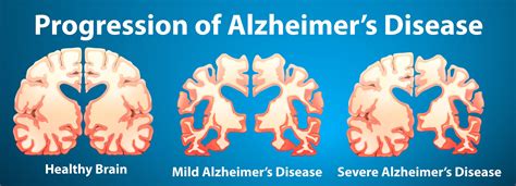 阿尔兹海默病（alzheimers Disease）的微生物起源论 知乎