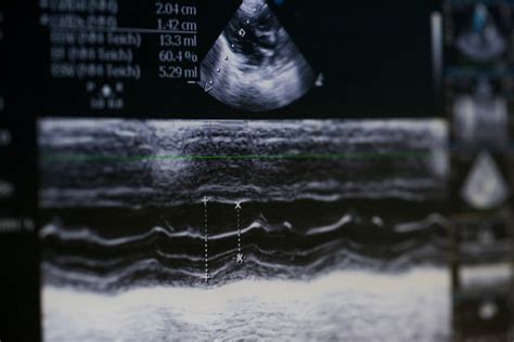 What Is A Heart Ultrasound Two Views