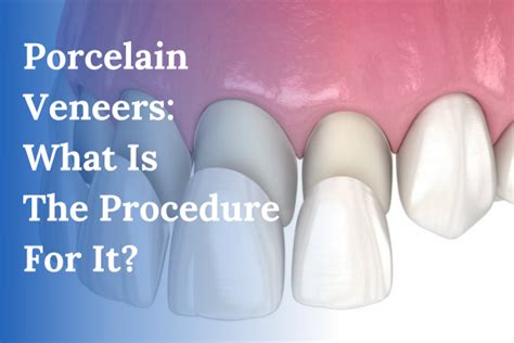 Porcelain Veneer What Is The Procedure For It