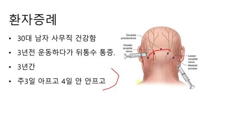 날씨가 추워지면서 후두신경통을 호소하는 분이 많습니다 후두 신경통의 원인과 치료에 대해서 알아보았습니다 Youtube