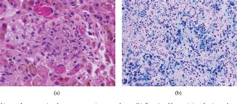 Figure 1 from Mycobacterium avium Complex Infection in a Patient with ...