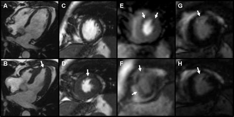 Cardiac Magnetic Resonance Imaging Cine Mri Dipyridamole Stress