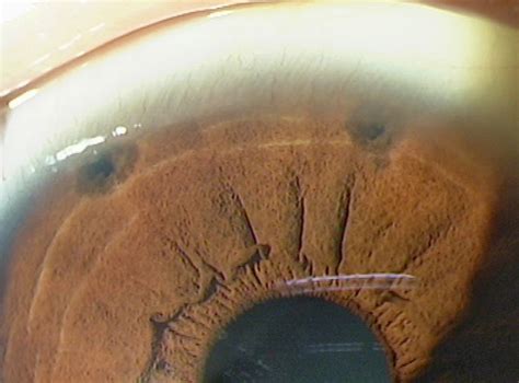 All things eye | Por Yong Ming: How is glaucoma treated?