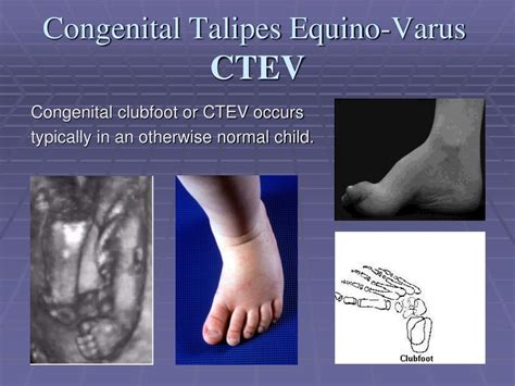 Ppt Congenital Talipes Equino Varus Congenital Clubfoot Powerpoint Presentation Id5730720