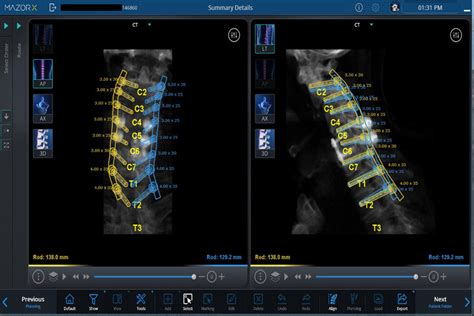 Case 3 Preoperative Planning For Robotic Assisted Placement Of