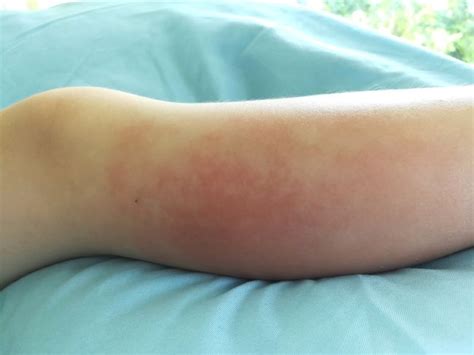 What Is Cellulitis? | Live Science