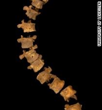 A case of scoliosis: Richard III's spine was twisted, not hunched - CNN.com