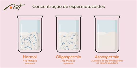 Azoospermia Não Obstrutiva Infertilidade E Reprodução Assistida Qual