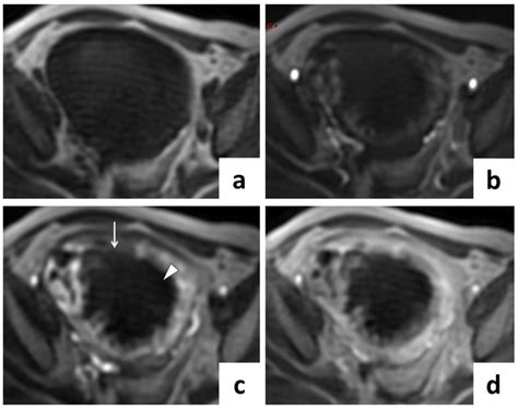 Pelvic Mri Of Leiomyosarcoma A B C D Axial Dce Mri Without