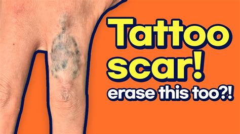 Tattoo Scars And Burn Scars Can Be Treated Together Youtube