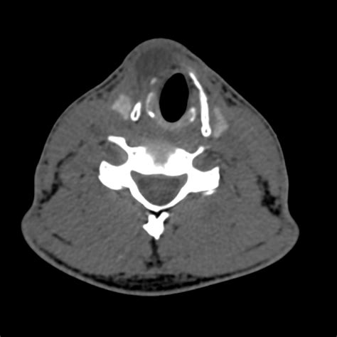 Radiopaedia case Laryngocele - external id: 23478 study: 23560 - NC Commons