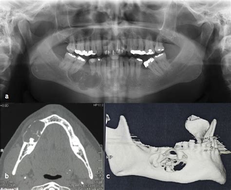 A Panoramic Radiograph Showing A Multilocular Radiolucent Area