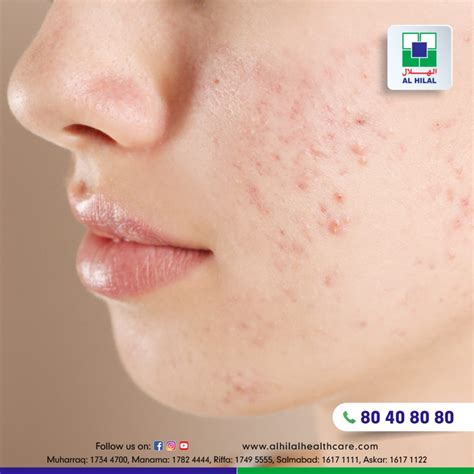 Understanding Acne Vulgaris Causes Symptoms And Treatment Options