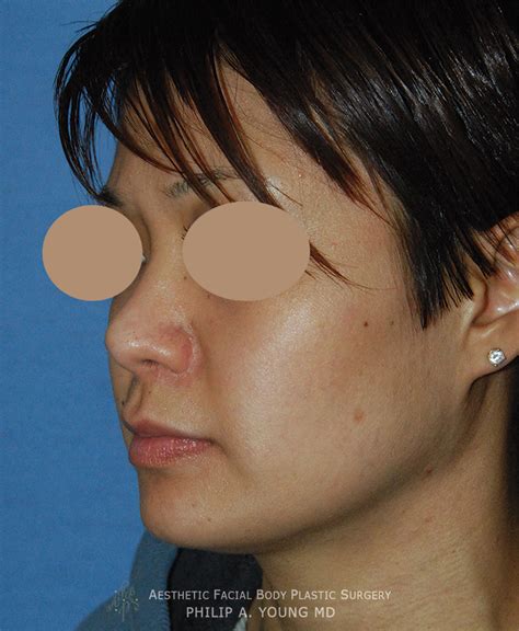 Asian Ethnic Rhinoplasty Seattle Bellevue