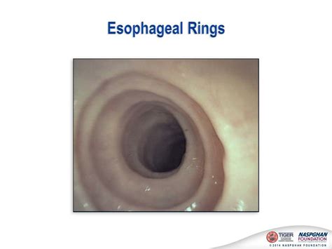 Ppt Eosinophilic Esophagitis Diagnosis And Management 2nd Edition Core