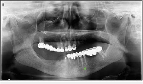 anterior loop detection   panoramic radiograph anterior loop