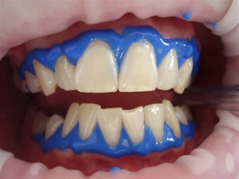 Carbamide Peroxide Teeth Whitening: Safety, Risks & Alternatives ...