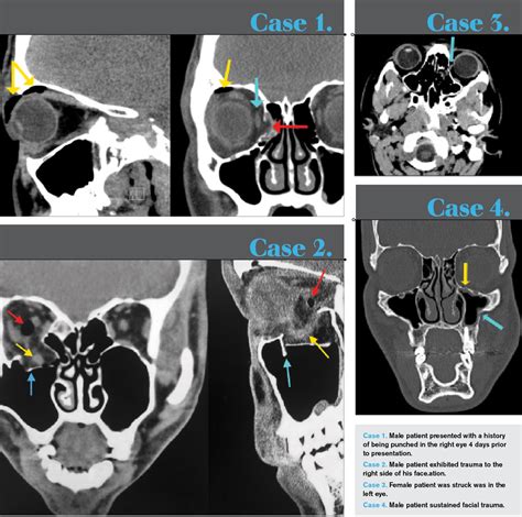 trapdoor fracture orbital floor radiology viewfloorco