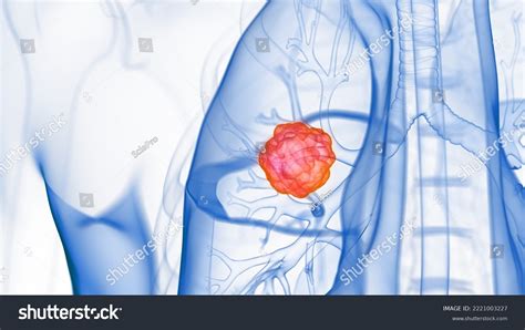 3d Rendered Medical Illustration Lung Tumor Stock Illustration