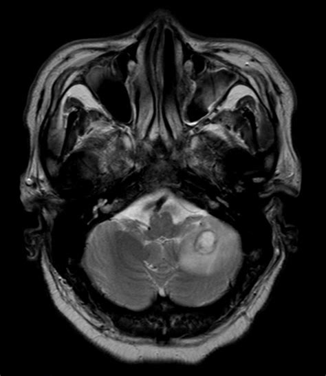 Figure 3 Cranial Mri Scan Axial T2w Tse Showing A Single Lesion In