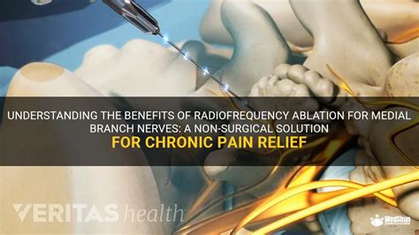 Understanding The Benefits Of Radiofrequency Ablation For Medial Branch