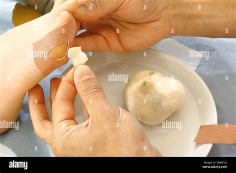 Plantar wart treatment Stock Photo - Alamy