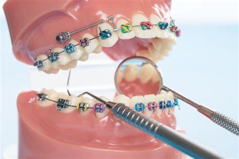 What Are The Advantages And Disadvantages Of Conventional Braces