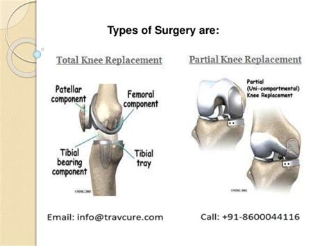 Orthopedic Surgery For Knee Replacement