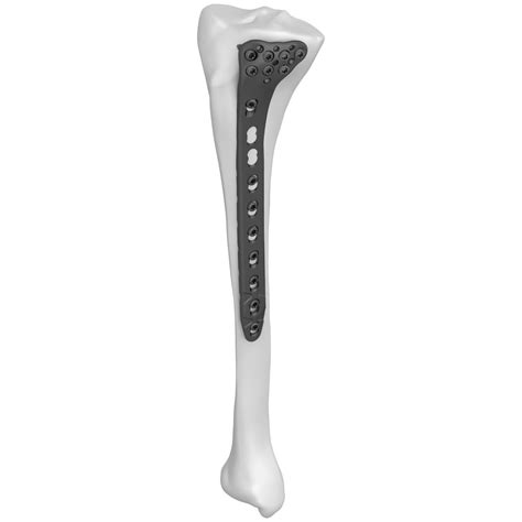 Tibia Compression Plate Series Boneunion Medical Proximal