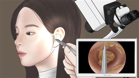 [asmr] 편안한 귀 청소 대왕 귀지 제거 Ear Cleaning And Big Ear Wax Removal Youtube