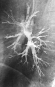 Bronchography - radiologystar