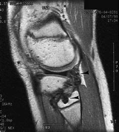 PVNS knee | Joint fluid, Magnetic resonance imaging, Things under a ...