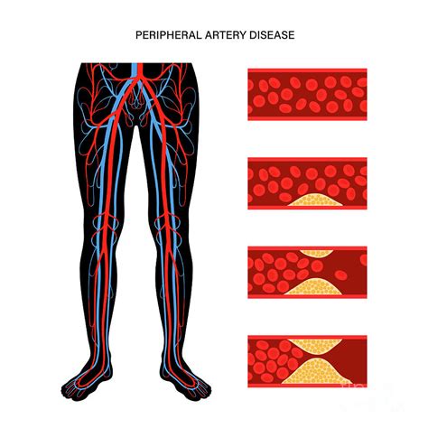 Peripheral Artery Disease Photograph By Pikovit Science Photo Library